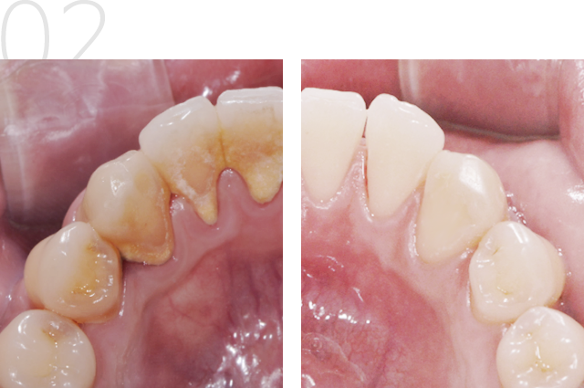 Teeth scaling